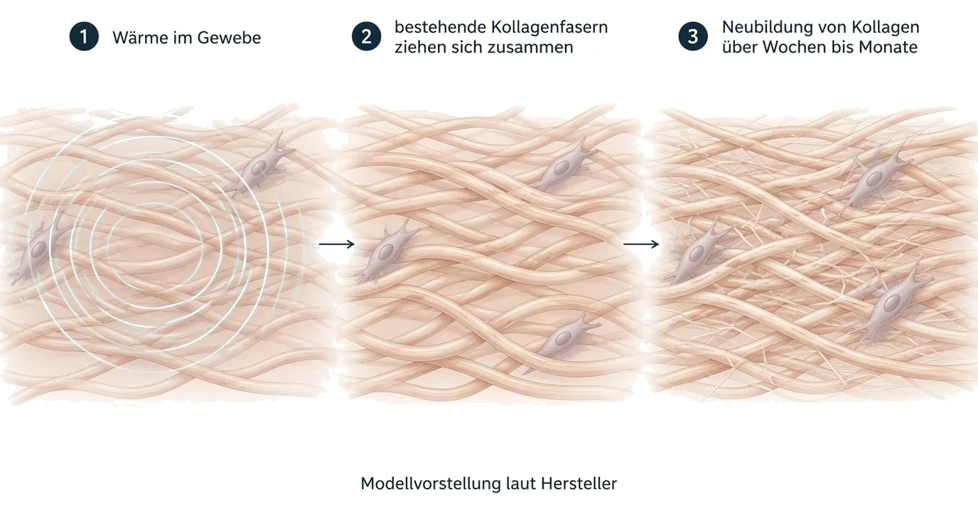 Wirkmechanismus laut Hersteller in drei Stufen: Wärme im Gewebe, Zusammenziehen bestehender Kollagenfasern, Neubildung von Kollagen über Wochen bis Monate.