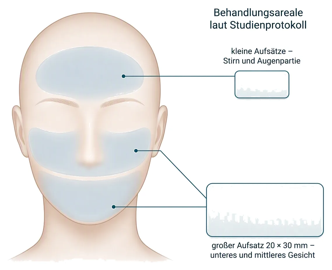 Behandlungsaufsätze von XERF schematisch: großer Aufsatz 20 × 30 mm für unteres und mittleres Gesicht, kleine Aufsätze für Stirn und Augenpartie.